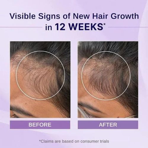 Bare Anatomy Rosemary & Hibiscus Hair Growth Oil (100 ml)